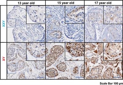 In vitro propagation of XXY human Klinefelter spermatogonial stem cells: A step towards new fertility opportunities